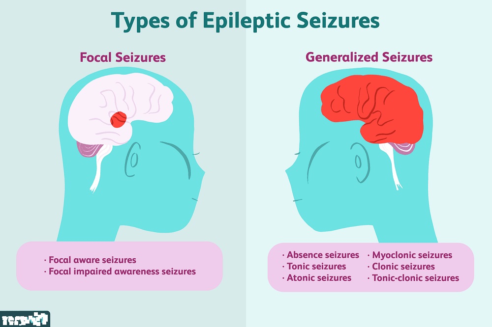 Epilepsy/Seizures